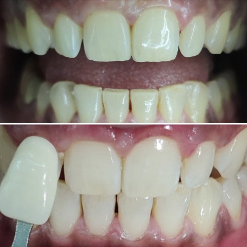 bharvi-whitening-before-after