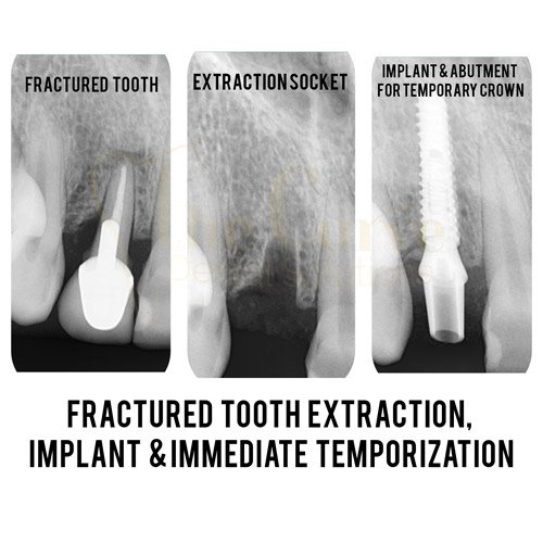 implant20220419_131251